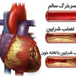 درمان بیماری گرفتگی عروق قلبی از منظر طب سنتی و قرآنی