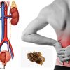 10 نسخه گیاهی ساده و موثر جهت درمان سنگ کلیه